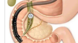ercp.png