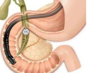 ercp.png